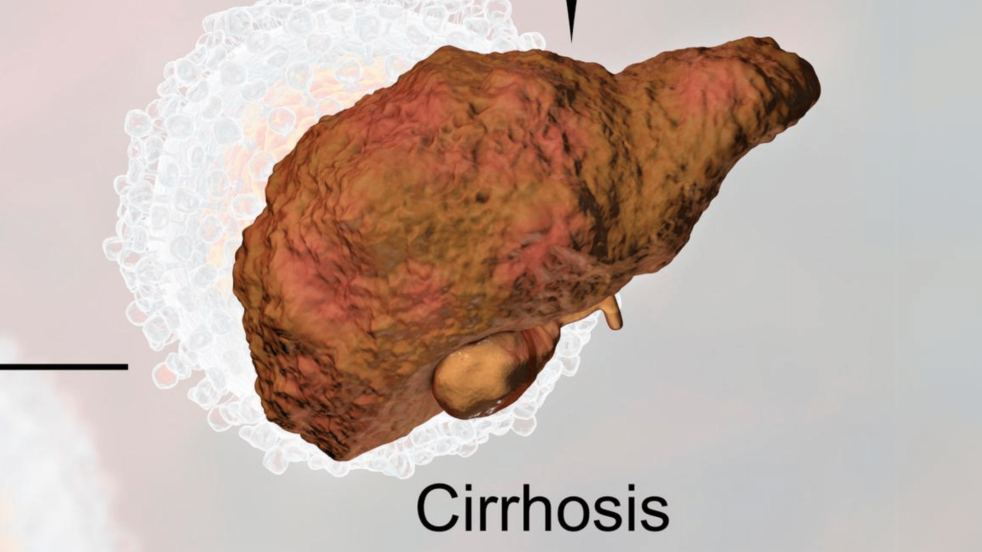 Cirrhosis of the Liver Services